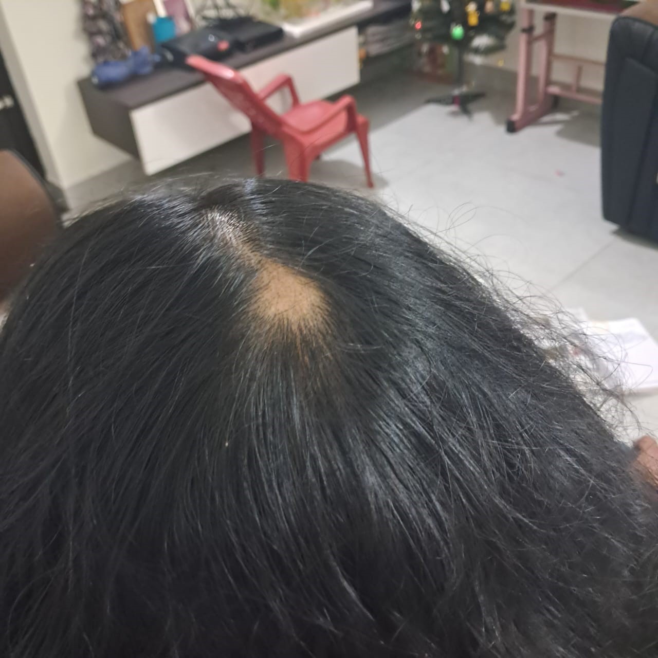 Alopecia Areata 2