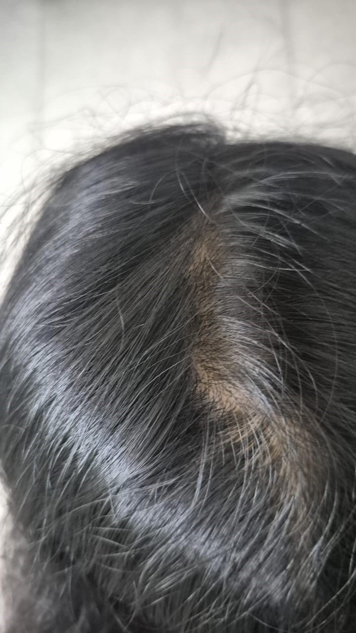Alopecia Areata 3