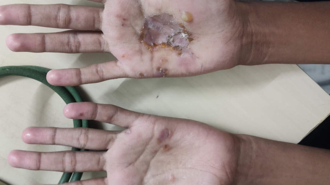 Dyshidrotic Eczema